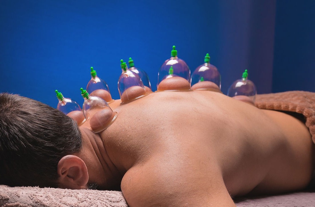 Dry Cupping